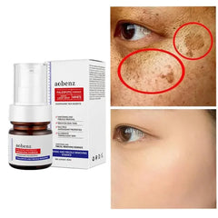 Niacinamide Serum Remove Dark Spots Melasma Chloasma Black Freckle Face Skin Care CreamWhitening Moisture Powerful Removal