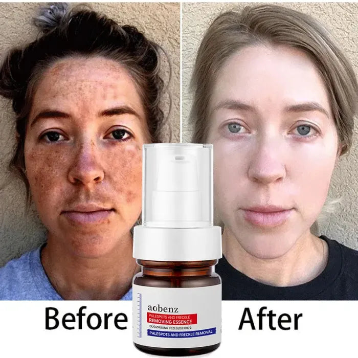 Niacinamide Serum Remove Dark Spots Melasma Chloasma Black Freckle Face Skin Care CreamWhitening Moisture Powerful Removal