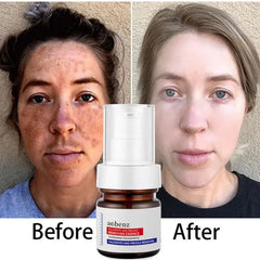 Niacinamide Serum Remove Dark Spots Melasma Chloasma Black Freckle Face Skin Care CreamWhitening Moisture Powerful Removal