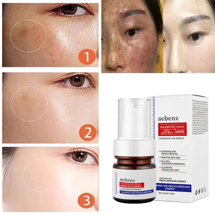 Niacinamide Serum Remove Dark Spots Melasma Chloasma Black Freckle Face Skin Care CreamWhitening Moisture Powerful Removal