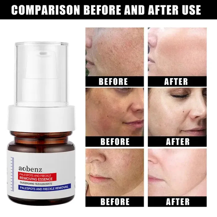 Niacinamide Serum Remove Dark Spots Melasma Chloasma Black Freckle Face Skin Care CreamWhitening Moisture Powerful Removal