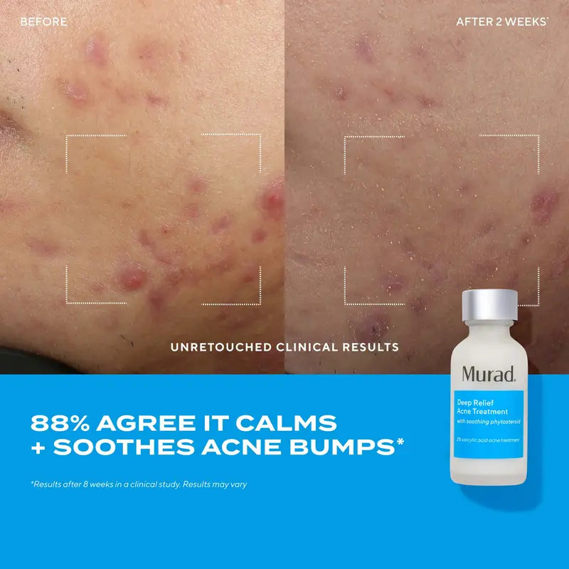 Deep Relief Acne Treatment [ Exclusive 2 Pack]