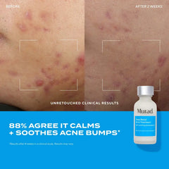 Deep Relief Acne Treatment [ Exclusive 2 Pack]