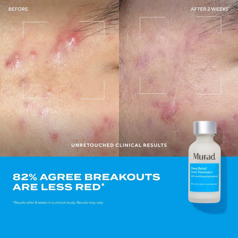Deep Relief Acne Treatment [ Exclusive 2 Pack]