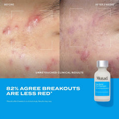 Deep Relief Acne Treatment [ Exclusive 2 Pack]